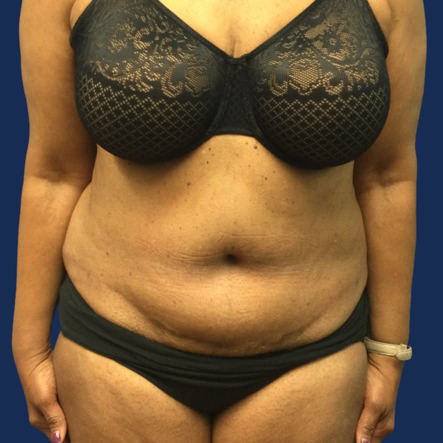 Tummy Tuck (Abdominoplasty) After, Female 68 - 3598