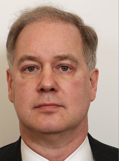 Blepharoplasty After, Male 57 - 19