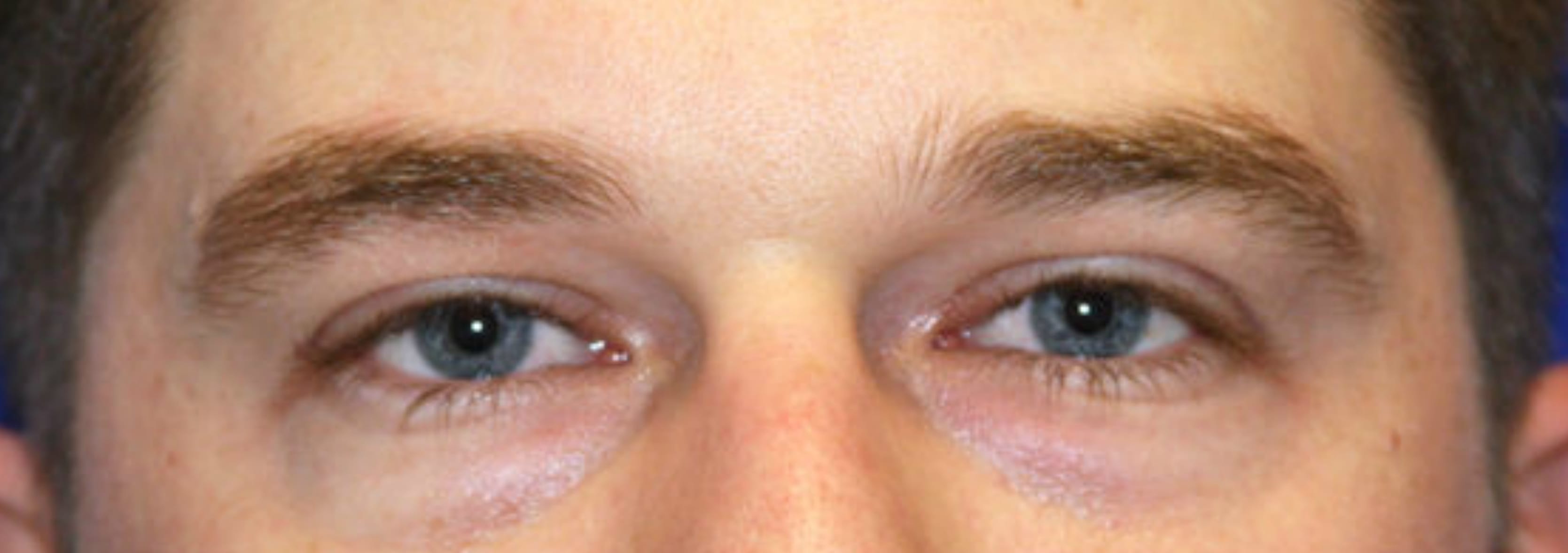 Blepharoplasty Before, Male 30 - 112