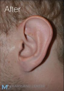 Earlobe Restoration Solutions After, Male 29 - 1854