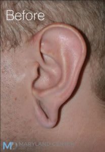 Earlobe Restoration Solutions Before, Male 29 - 1854