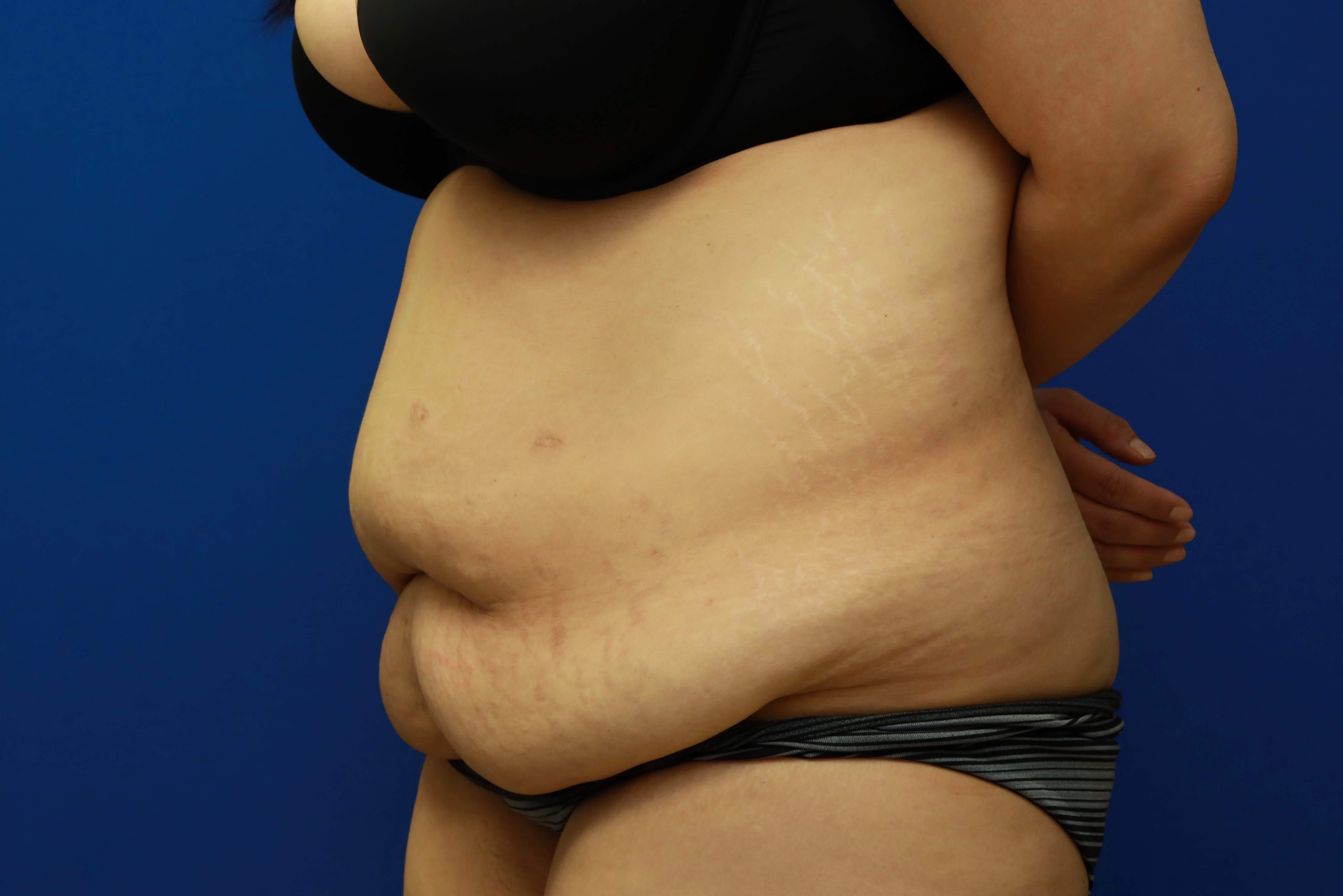 Tummy Tuck (Abdominoplasty) Before, Female 36 - 1658