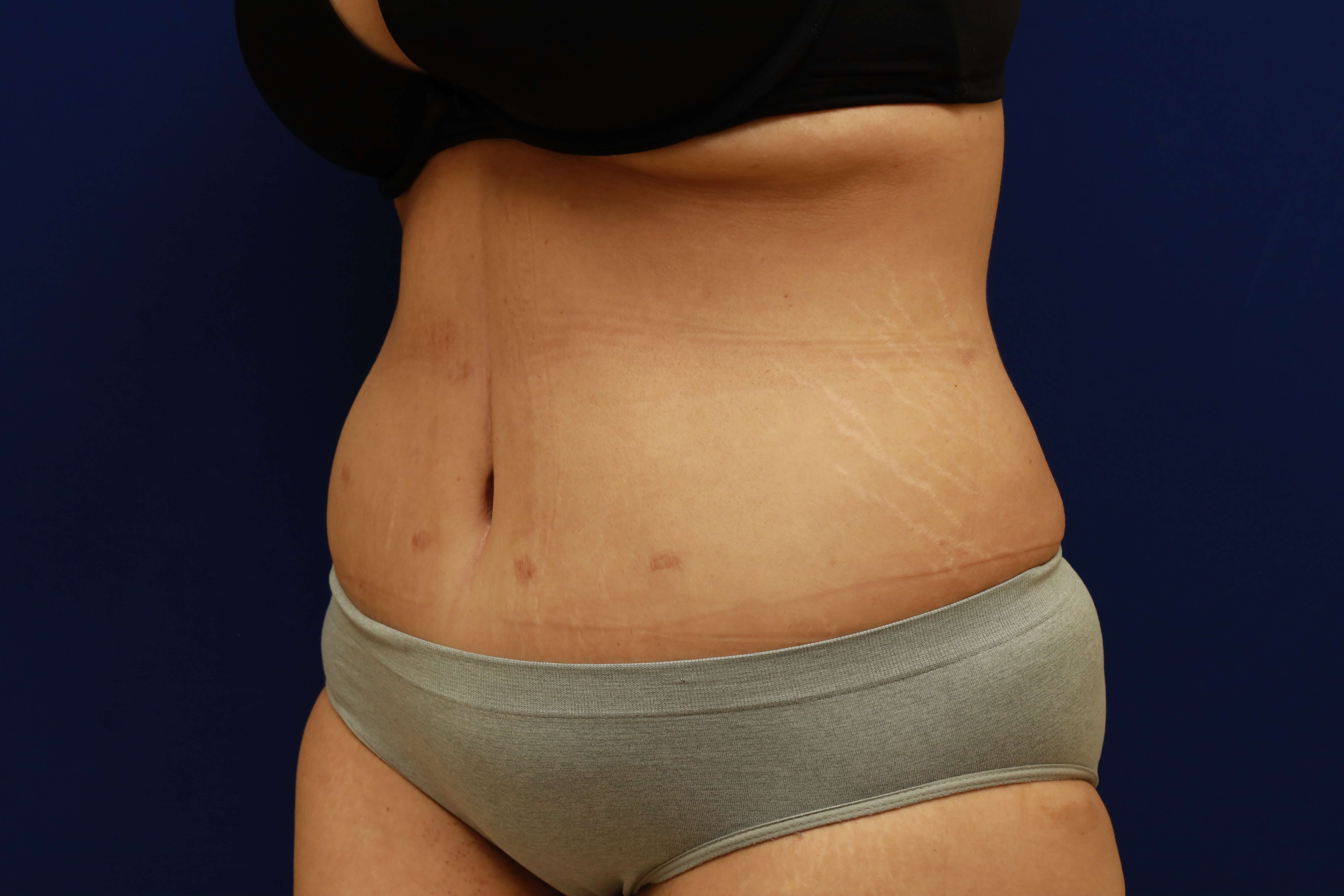 Tummy Tuck (Abdominoplasty) After, Female 36 - 1658