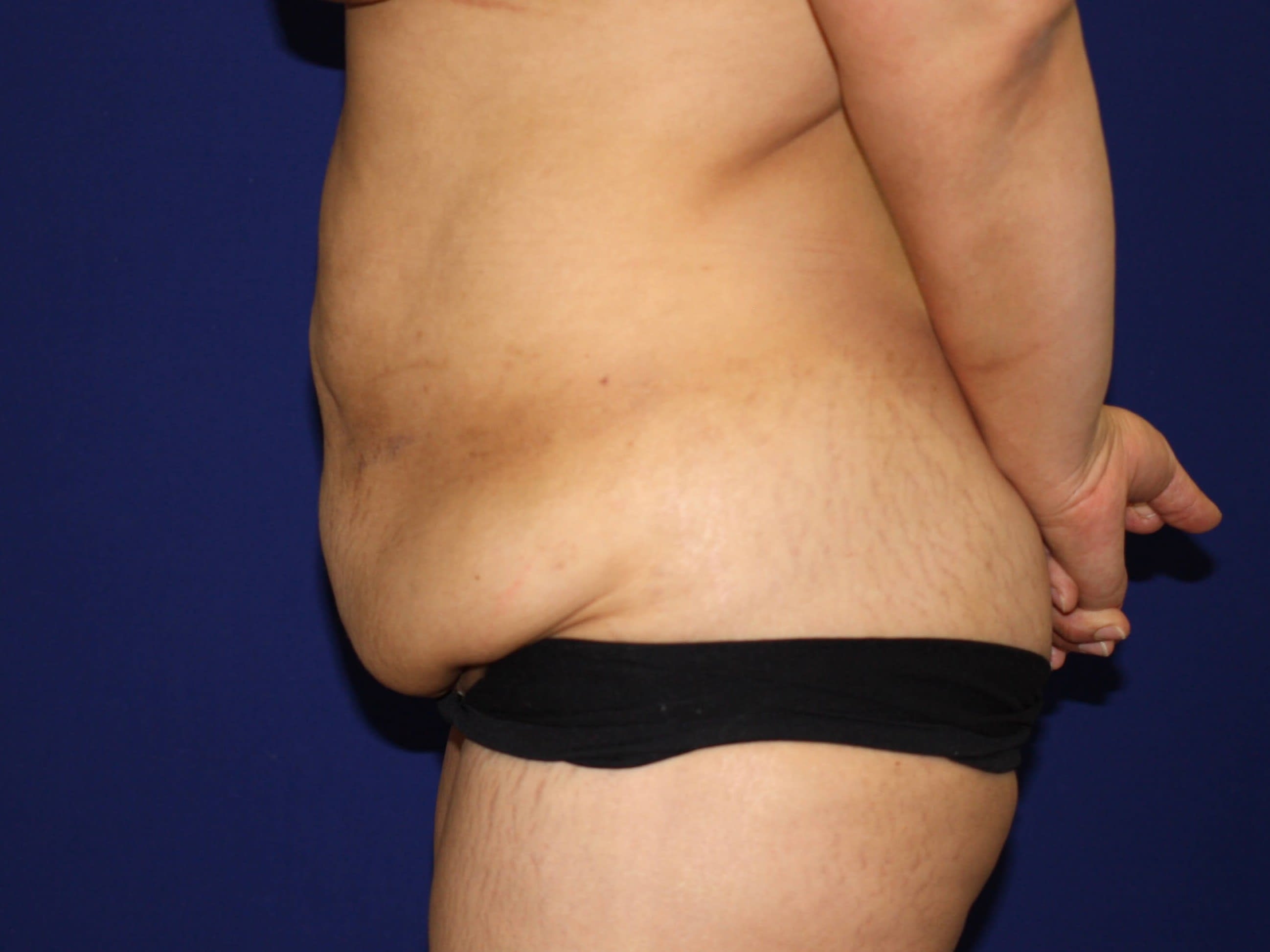 Tummy Tuck (Abdominoplasty) Before, Female 42 - 1625