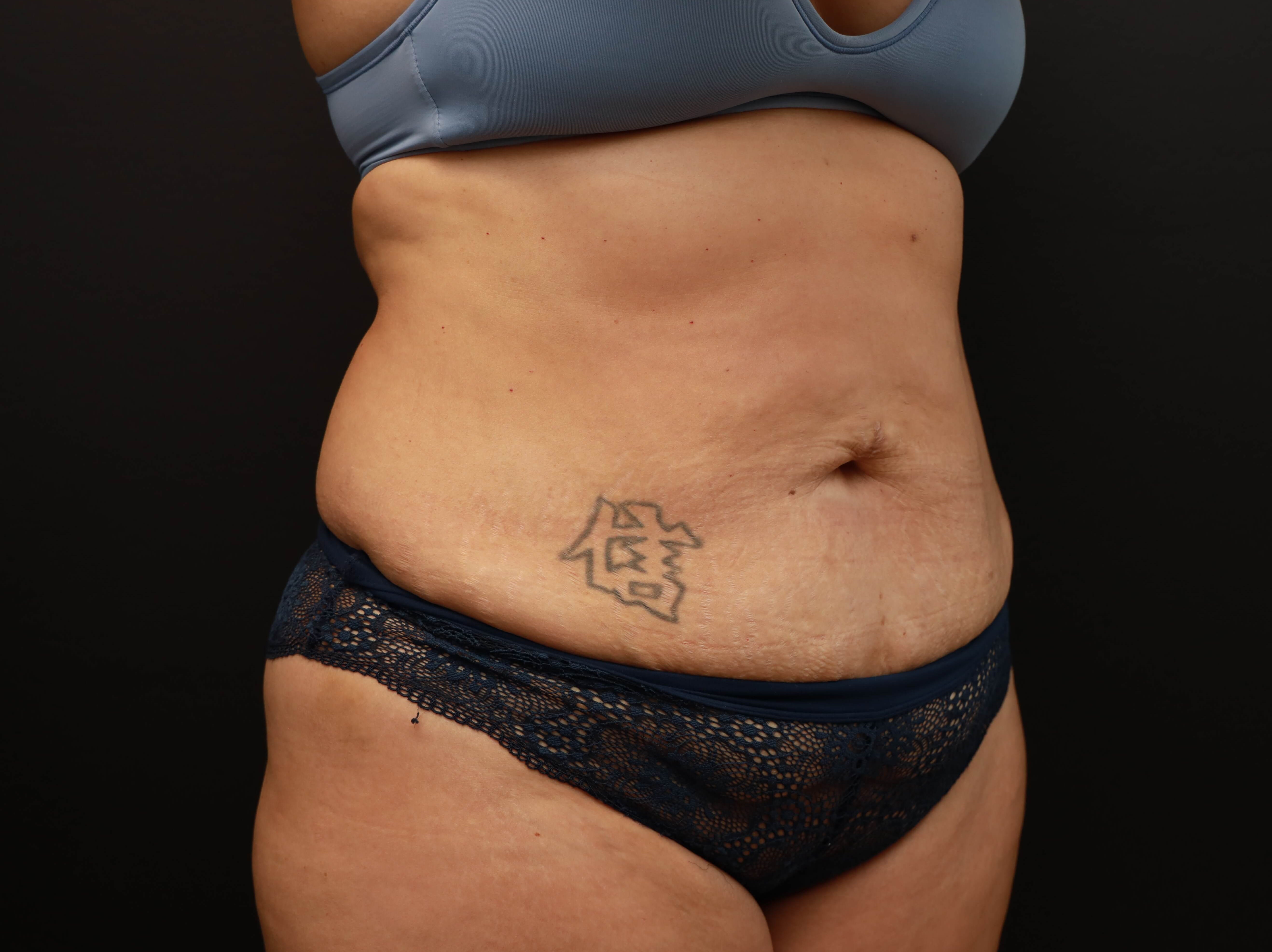 Tummy Tuck (Abdominoplasty) Before, Female 45 - 1624