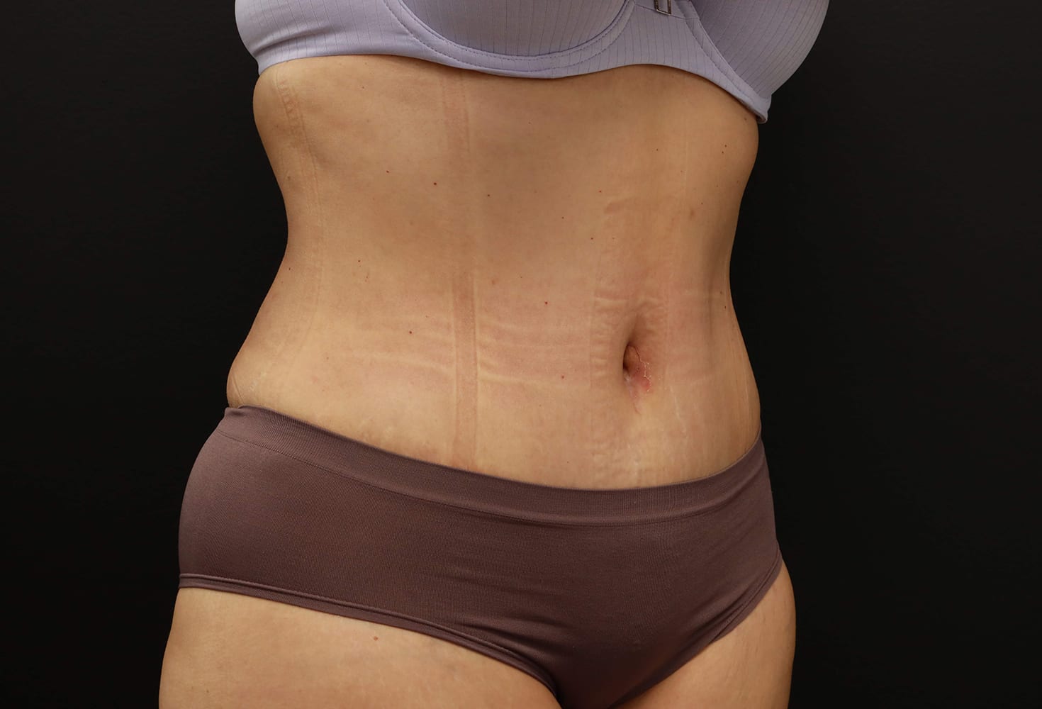Tummy Tuck (Abdominoplasty) After, Female 45 - 1624