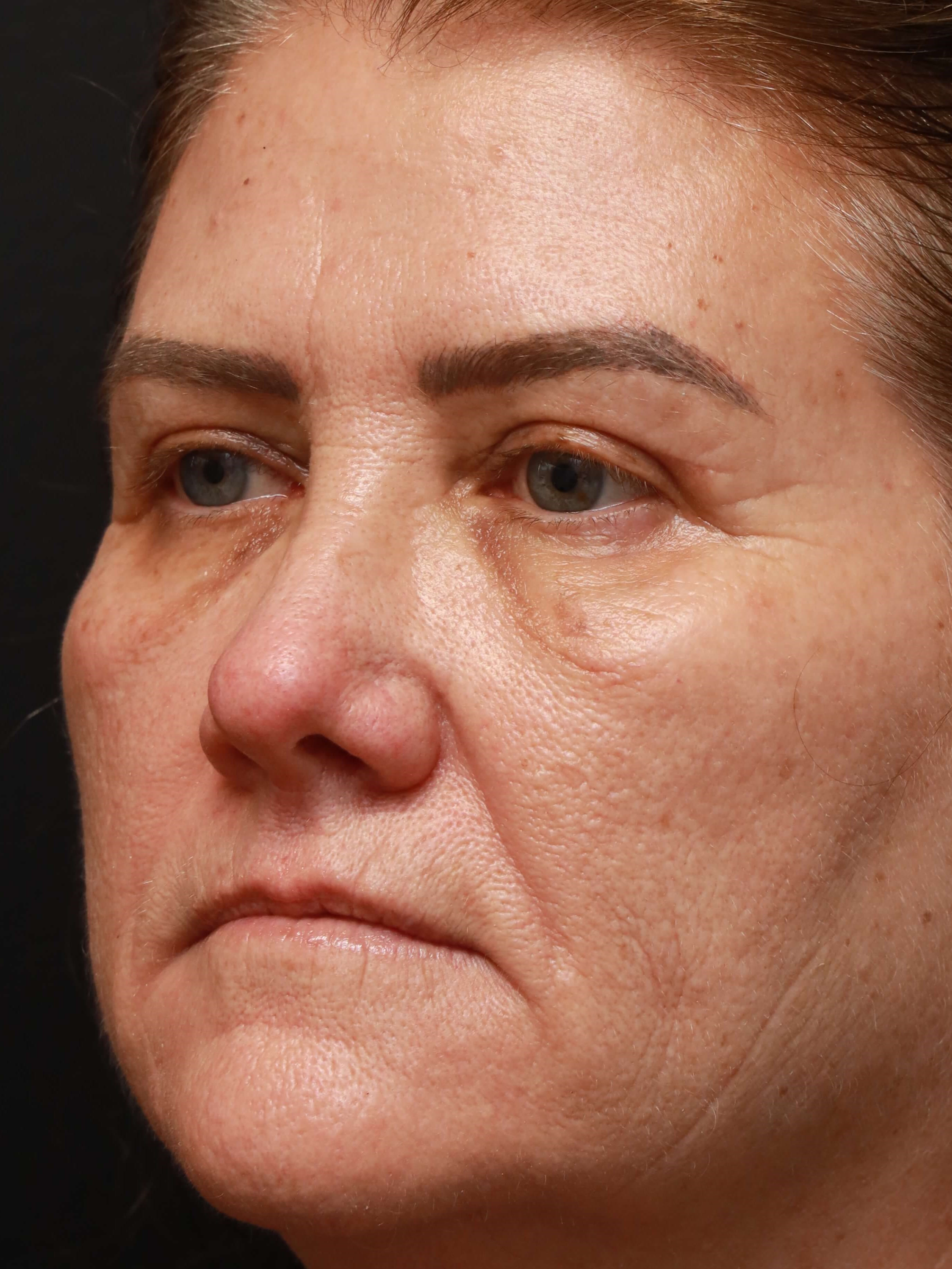 Blepharoplasty After, Female 58 - 1630