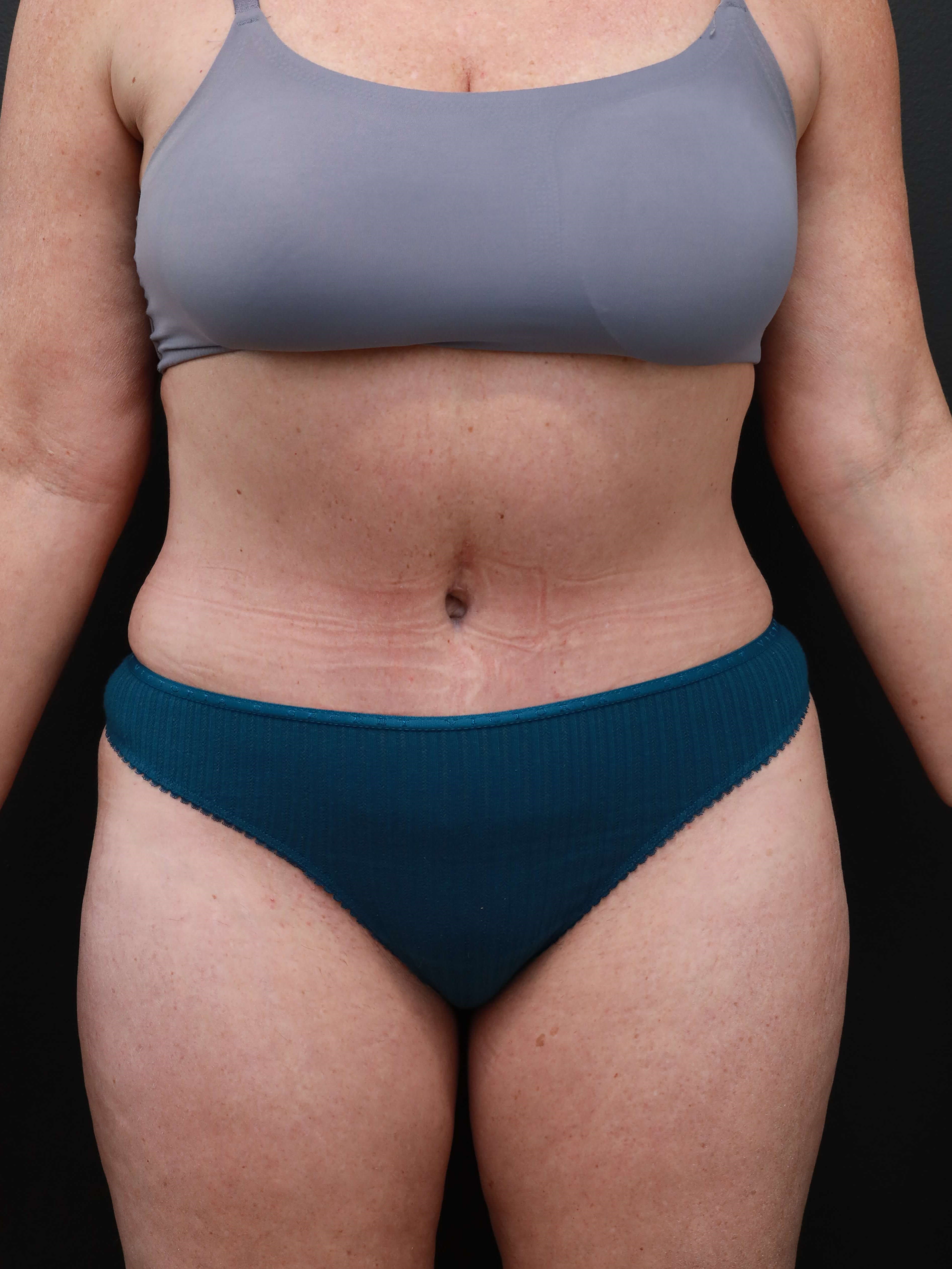 Tummy Tuck (Abdominoplasty) After, Female 47 - 1623