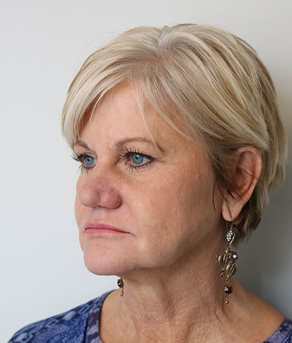 Facelift Before, Female 62 - 2358