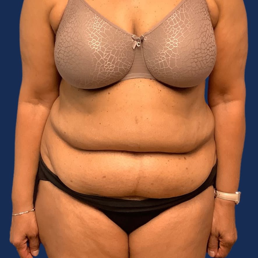 Tummy Tuck (Abdominoplasty) Before, Female 68 - 3598