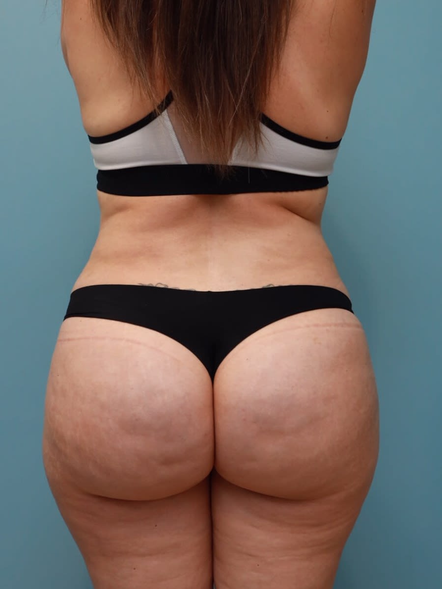 Liposuction After, Female 43 - 1632