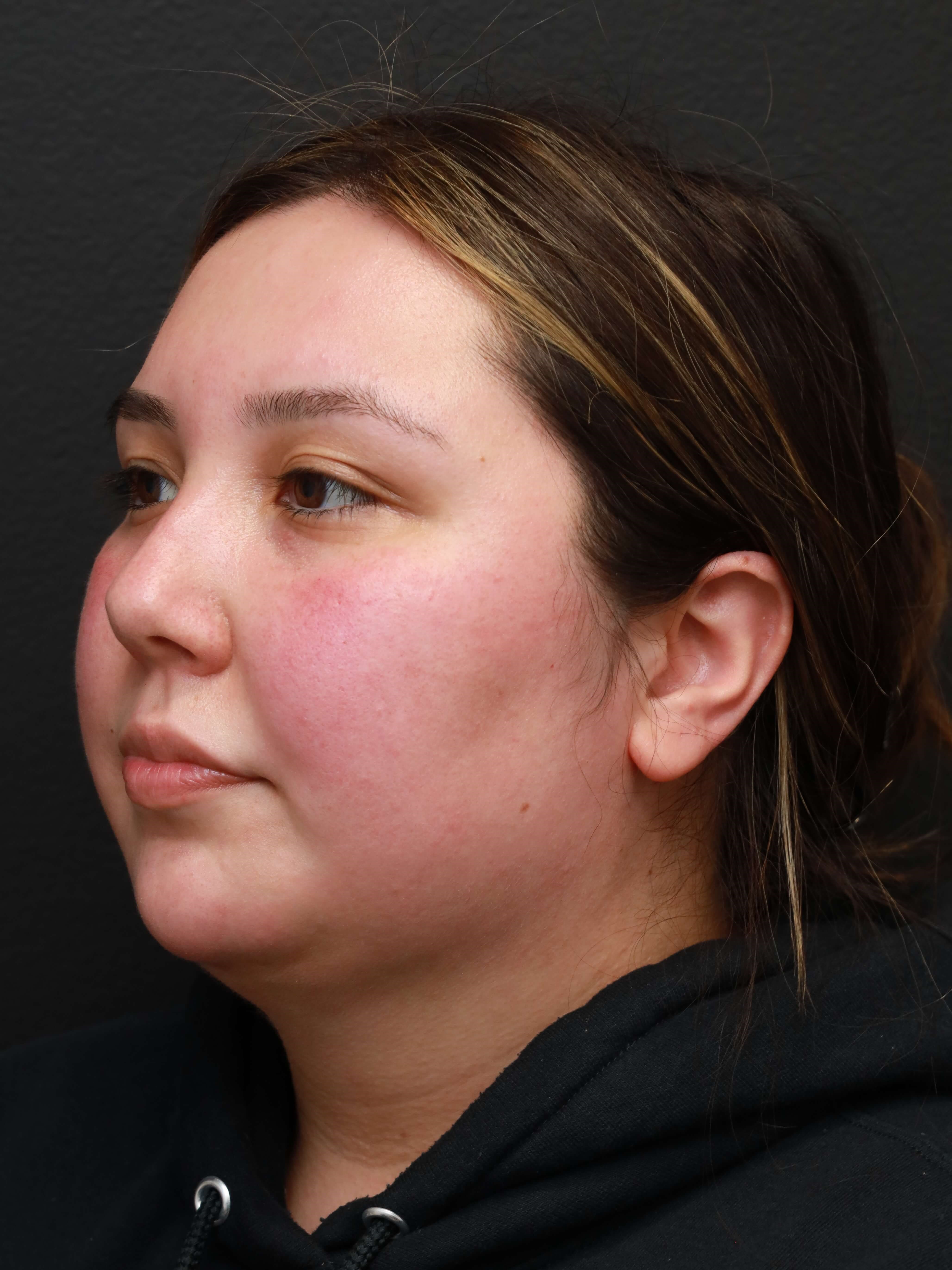 Liposuction After, Female 23 - 1631