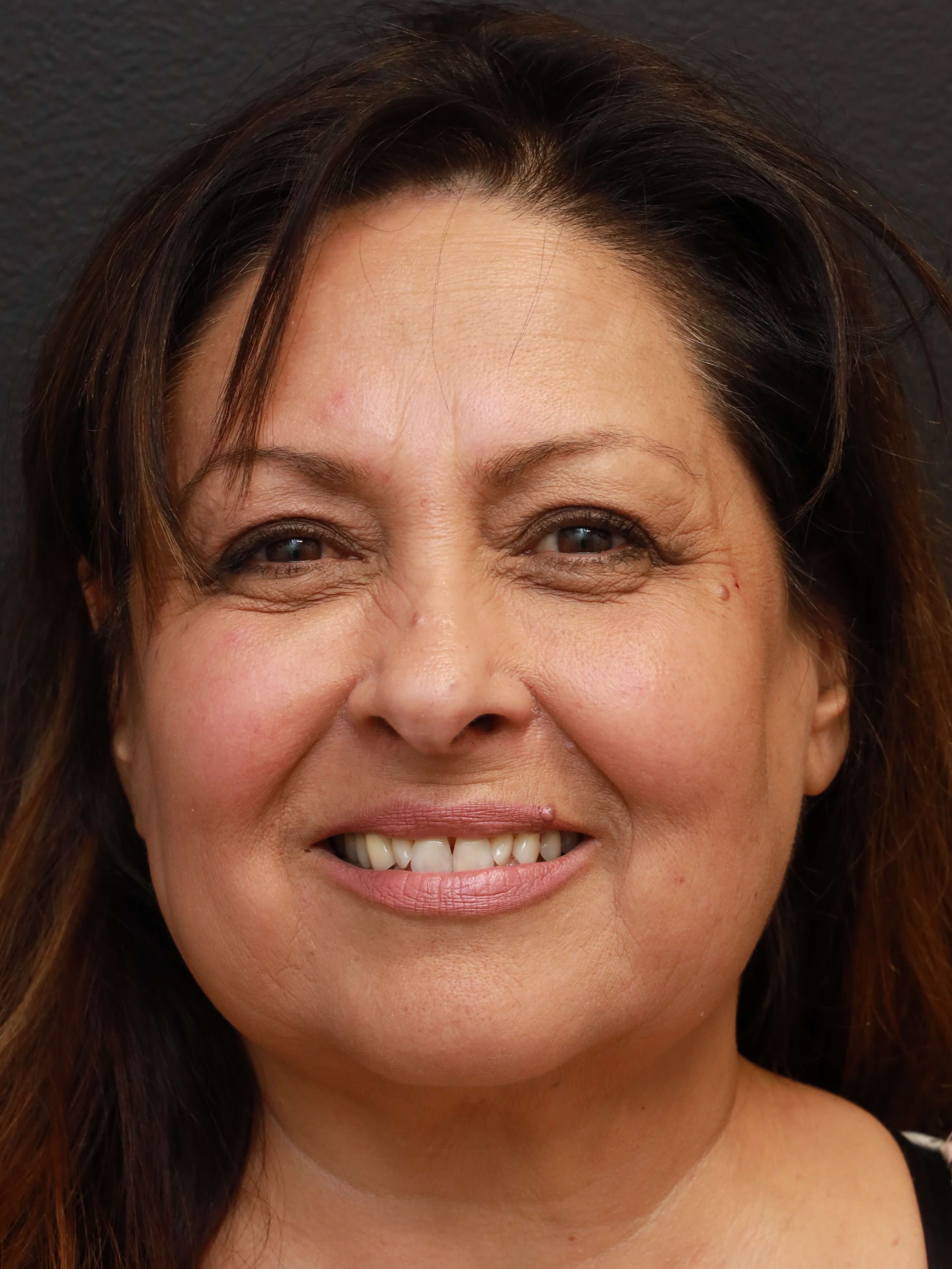 Blepharoplasty After, Female 61 - 1629