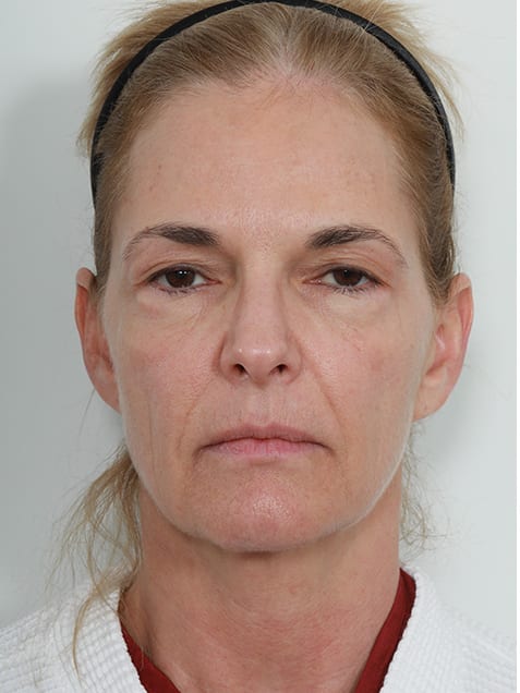 Blepharoplasty Before, Female 57 - 20