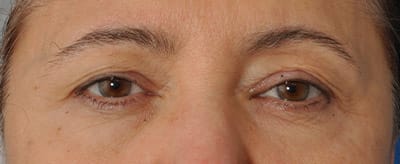 Blepharoplasty Before, Female 47 - 3210
