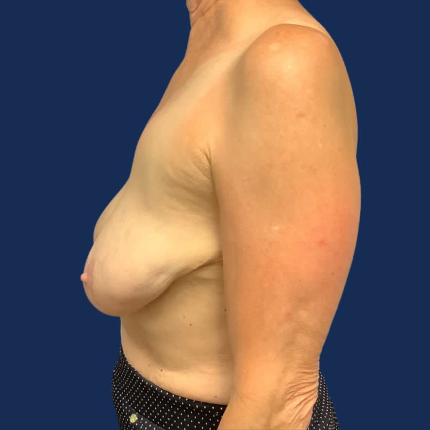 Breast Lift (Mastopexy) Before, Female 63 - 3594