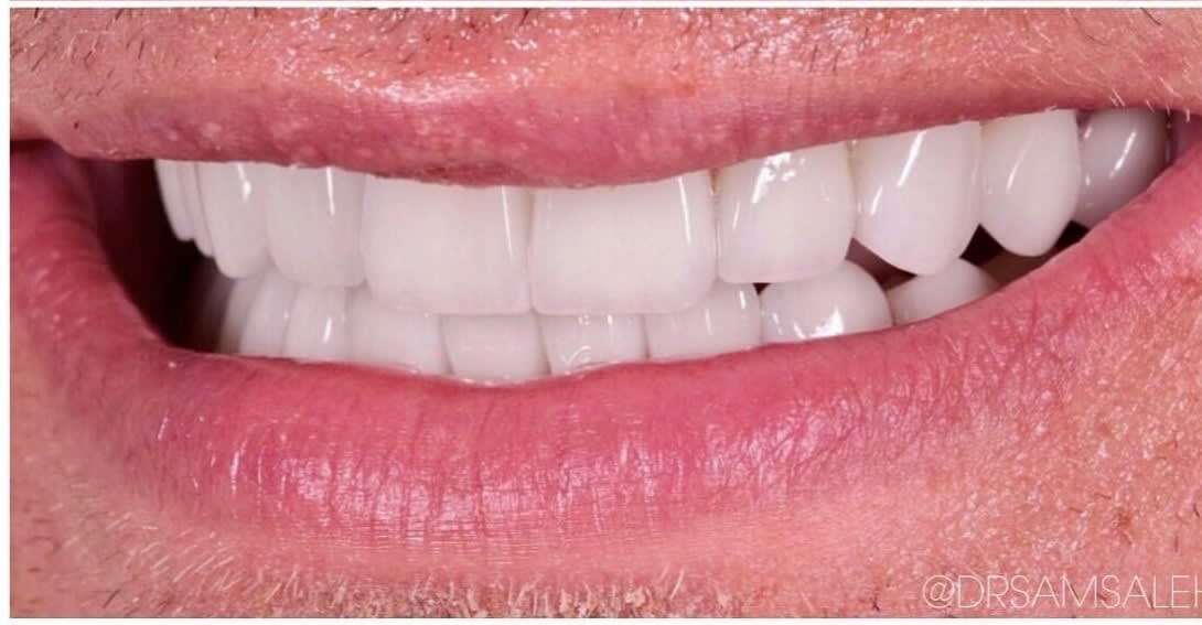 Dental Veneers After, Male 45 - 180