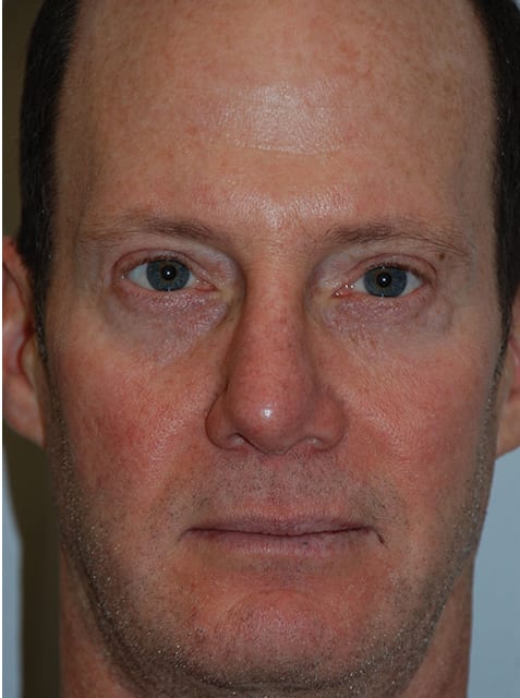 Blepharoplasty After, Male 57 - 14