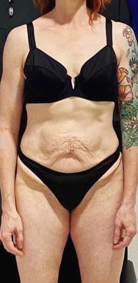 Abdominoplasty Before, Female 41 - 2064