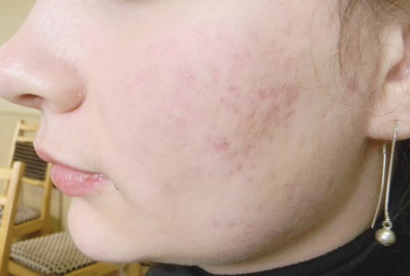 Accutane After, Female 25 - 4094