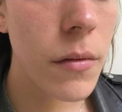 Dermal Fillers & Injectables After, Female 27 - 1712