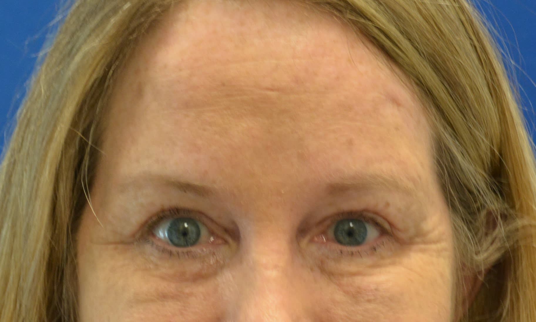 Brow Lift After, Female 50 - 1516