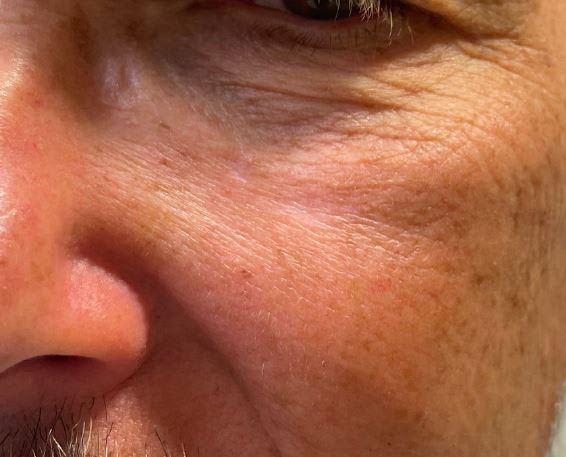 Birthmark, Mole, & Skin Growth Removal Solutions After, Male 65 - 4135