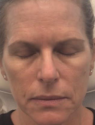 Juvéderm® Before, Female 47 - 2323