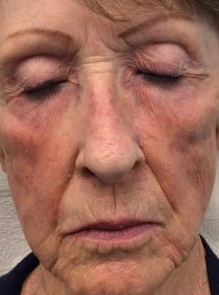 Cheek Augmentation with Fillers Before, Female 74 - 2326