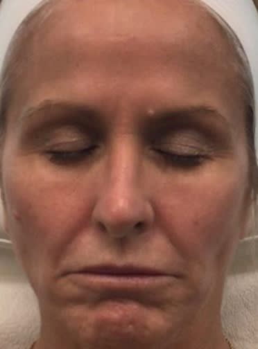Dermal Fillers & Injectables Before, Female 51 - 2325