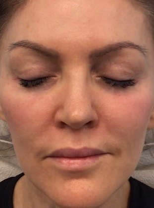 Dermal Filler & Injectable Solutions After, Female 41 - 2328