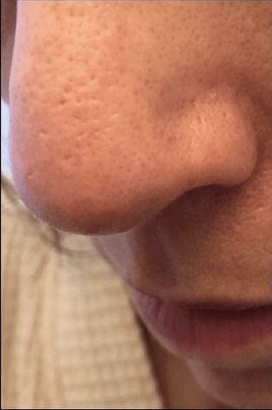 Microneedling Before, Female 41 - 259
