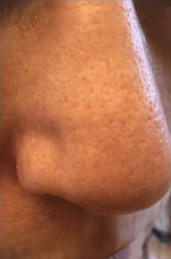 Microneedling Before, Female 41 - 256