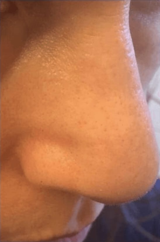 Microneedling After, Female 41 - 256