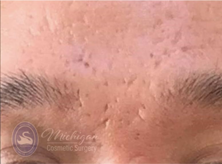 Acne Treatment After, Male 38 - 4280