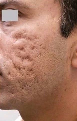 Acne Scar Solutions Before, Male 33 - 2337