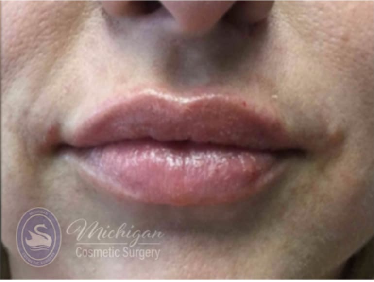 Dermal Fillers & Injectables After, Female 30 - 4283