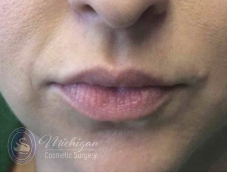 Dermal Fillers & Injectables Before, Female 30 - 4283