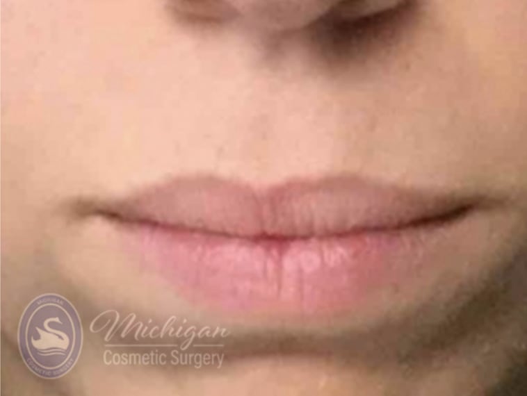 Dermal Fillers & Injectables Before, Female 30 - 4284