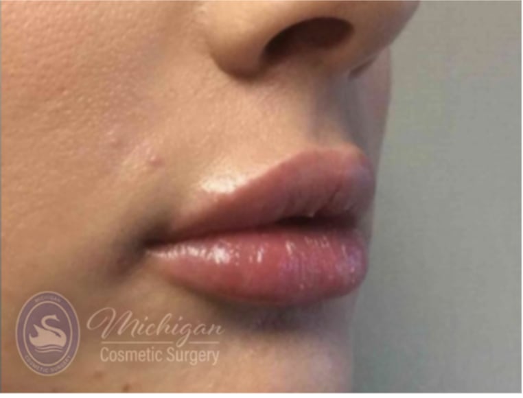 Dermal Fillers & Injectables After, Female 27 - 4285