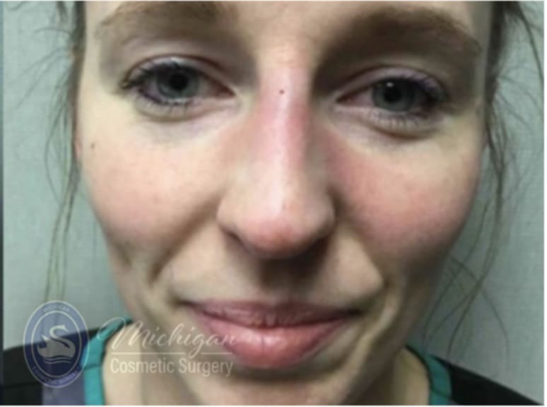 Dermal Fillers & Injectables After, Female 35 - 4286