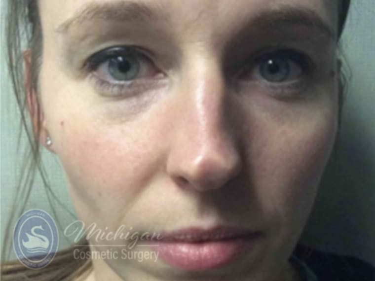 Dermal Fillers & Injectables Before, Female 35 - 4286