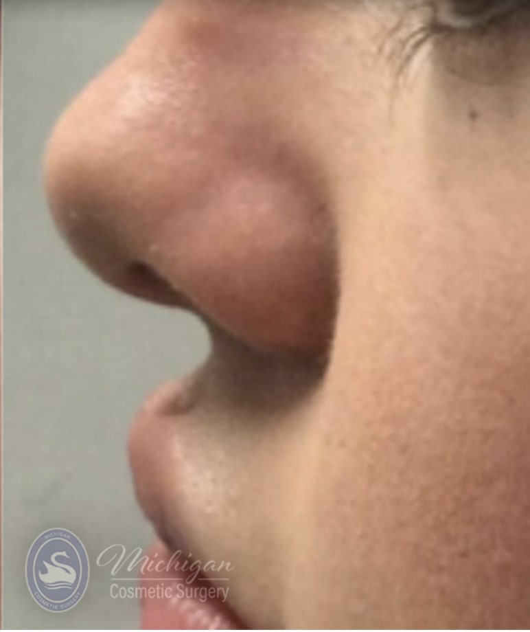 Dermal Fillers & Injectables After, Female 24 - 4288