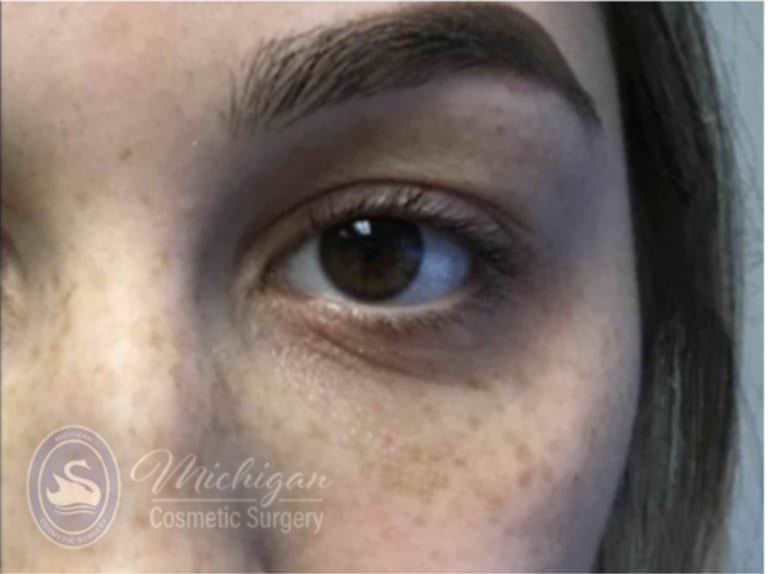 Dermal Fillers & Injectables After, Female 28 - 4287