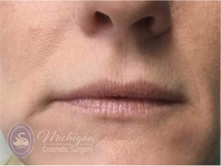 Dermal Fillers & Injectables Before, Female 40 - 4289