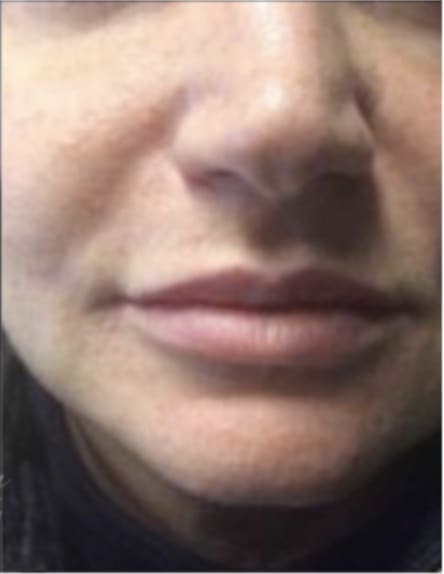 Dermal Fillers & Injectables After, Female 31 - 4290
