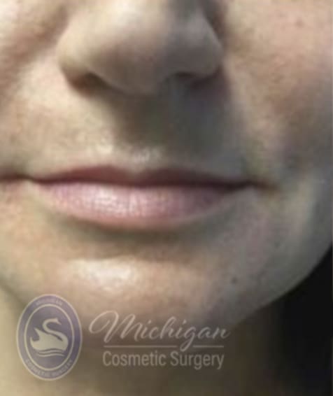 Dermal Fillers & Injectables Before, Female 31 - 4290