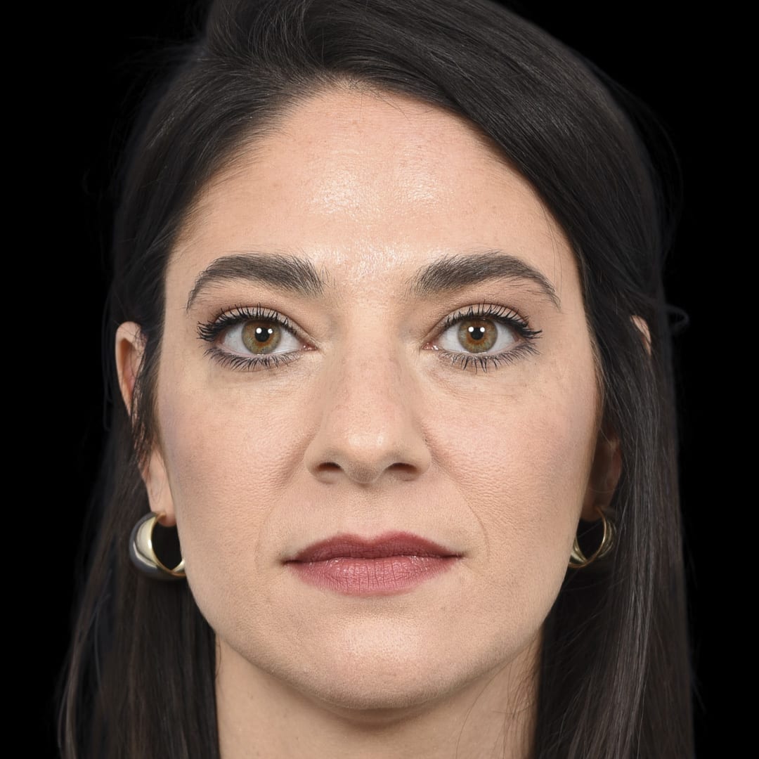 Botox After, Female 33 - 4888