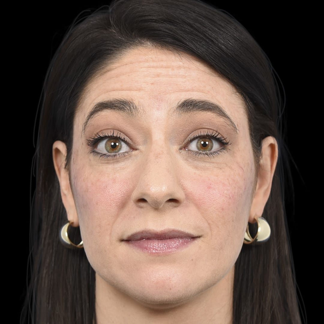 Botox Before, Female 33 - 4888