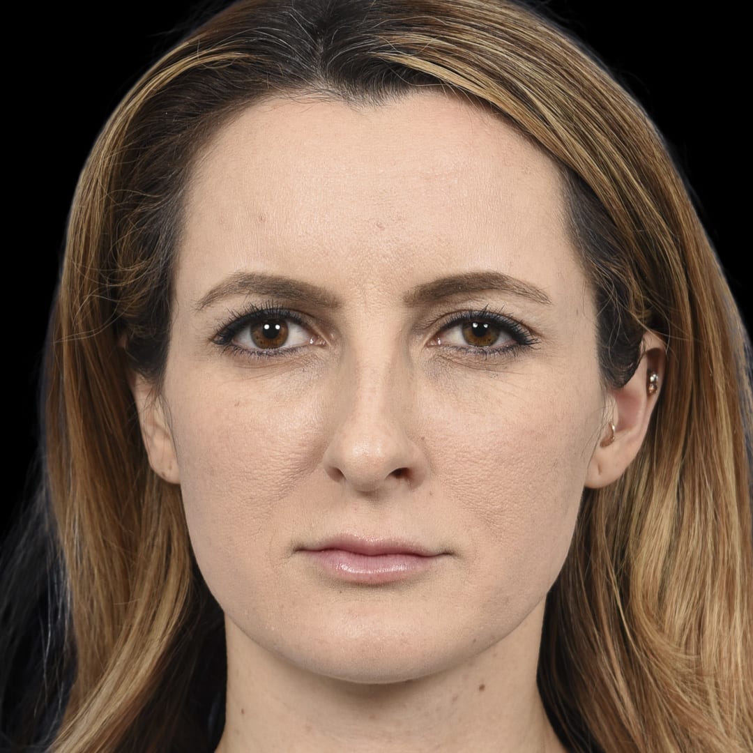 Botox After, Female 28 - 4890